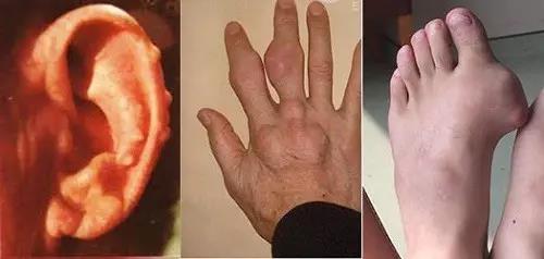 久患痛风,不愿再做“活着的僵尸”!! 久患痛风,不愿再做“活着的僵尸”!!