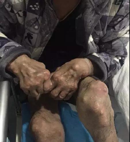 久患痛风,不愿再做“活着的僵尸”!! 久患痛风,不愿再做“活着的僵尸”!!