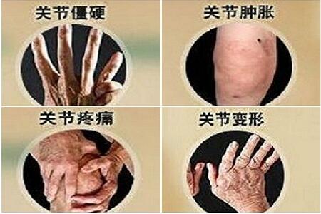 我们都知道类风湿是一种全身性慢性疾病,病程较长,尤其是发病时患者常独自承受着巨大的痛苦,因此患者很容易产生焦虑、烦躁、恐慌、悲观等不良情绪,甚至有些患者会出现自暴自弃的情况,而此时若能得到亲朋好友的支持和帮助,对于类风湿患者来说,无疑是吃了一颗定心丸,对他们的病情恢复也是大有益处。 病痛更见兄弟情!“没事,我给你养老” 本期节目患者可以说是不幸的,因为他患类风湿已经缠绵病榻多年,饱受折磨,但他也可以说是幸运的,因为病痛更见真感情,兄弟的一句“没事,我给你养老”让他内心升起阵阵暖意,他知道他并不是一个人在“战斗”,这也更坚定了他与类风湿抗争到底的决心。 蒙兴文主任表示,类风湿患者在确诊疾病之后及时接受治疗非常重要,但在接受治疗过程中,家属及亲友的精神支持和心理抚慰的重要性,绝对不亚于医生的专业治疗,那么作为患者的亲友,该如何做才能更好的帮助到他们? 给类风湿患者家属及亲友的几个建议 1、经常与患者沟通 病人亲友要表现出与患者共渡难关的意愿,必须学会聆听,耐心听病人的倾诉,与病人相互坦诚交谈。当病人发脾气时要耐心,表示出对他(她)的理解,并搞清发脾气的原因是身体不舒服,还是由于照顾不周。若病人表现出不需要别人帮助,也要弄明白他(她)是真的不需要别人帮助,还是内心存在其他消极想法。 2、了解疾病相关知识 类风湿患者的日常护理很重要,因此患者亲友应多了解一些与类风湿疾病相关的知识,了解疾病会给患者带来哪些不适、了解疾病的治疗、药物的副作用等,以便更好的照顾类风湿患者的饮食起居。 3、 关注他但不要过度保护他 虽然类风湿关节炎会造成患者的部分行动不便,但是他仍然可以做很多力所能及的事情, 如果给予他过度的保护,就像父母对孩子的溺爱一样,会让患者难以融入社会。 4、引导患者积极配合医生治疗 家属要帮助患者建立起良好的心态,鼓励他积极治疗,并且陪伴他一起去看医生,这样不仅可以让患者感受到被支持的温暖,家属还有机会和医生对话,把疑问告诉医生并直接从医生那里获得专业解答。 5、不停地做调整和适应 类风湿关节炎本身就是一个慢性反复疾病,如果用一张图表来描述这个疾病,这个图表一定不是直线,而是一个上下起伏的曲线。 随着疾病的变化,患者需要不停地调整自己的心理、状态和生活方式。而作为患者的亲友也必须根据这些变化作出相应的调整和适应。 类风湿并非不治之症,正规治疗有助康复 蒙兴文主任提醒广大类风湿患者及其亲友,类风湿性关节炎不是绝症,随着医学上对类风湿的深入研究,以及治疗理念的不断更新,类风湿性关节炎已经是一个可防、可治的疾病。之所以大家认为类风湿性关节炎是不治之症,主要是由于不正规治疗引起的,若能早期诊断、正规治疗,类风湿性关节炎是可以得到很好的控制,甚至完全康复。 节目预告 面对疾病侵袭,类风湿患者及其家属应如何正确处理?类风湿不及时治疗会出现哪些危害?类风湿如何治疗才能有效控制病情发展?2017年9月29日CDTV-3《热线188》栏目将邀请我院医生蒙兴文主任现场讲解,节目详情敬请期待! 我们都知道类风湿是一种全身性慢性疾病,病程较长,尤其是发病时患者常独自承受着巨大的痛苦,因此患者很容易产生焦虑、烦躁、恐慌、悲观等不良情绪,甚至有些患者会出现自暴自弃的情况,而此时若能得到亲朋好友的支持和帮助,对于类风湿患者来说,无疑是吃了一颗定心丸,对他们的病情恢复也是大有益处。 病痛更见兄弟情!“没事,我给你养老” 本期节目患者可以说是不幸的,因为他患类风湿已经缠绵病榻多年,饱受折磨,但他也可以说是幸运的,因为病痛更见真感情,兄弟的一句“没事,我给你养老”让他内心升起阵阵暖意,他知道他并不是一个人在“战斗”,这也更坚定了他与类风湿抗争到底的决心。 蒙兴文主任表示,类风湿患者在确诊疾病之后及时接受治疗非常重要,但在接受治疗过程中,家属及亲友的精神支持和心理抚慰的重要性,绝对不亚于医生的专业治疗,那么作为患者的亲友,该如何做才能更好的帮助到他们? 给类风湿患者家属及亲友的几个建议 1、经常与患者沟通 病人亲友要表现出与患者共渡难关的意愿,必须学会聆听,耐心听病人的倾诉,与病人相互坦诚交谈。当病人发脾气时要耐心,表示出对他(她)的理解,并搞清发脾气的原因是身体不舒服,还是由于照顾不周。若病人表现出不需要别人帮助,也要弄明白他(她)是真的不需要别人帮助,还是内心存在其他消极想法。 2、了解疾病相关知识 类风湿患者的日常护理很重要,因此患者亲友应多了解一些与类风湿疾病相关的知识,了解疾病会给患者带来哪些不适、了解疾病的治疗、药物的副作用等,以便更好的照顾类风湿患者的饮食起居。 3、 关注他但不要过度保护他 虽然类风湿关节炎会造成患者的部分行动不便,但是他仍然可以做很多力所能及的事情, 如果给予他过度的保护,就像父母对孩子的溺爱一样,会让患者难以融入社会。 4、引导患者积极配合医生治疗 家属要帮助患者建立起良好的心态,鼓励他积极治疗,并且陪伴他一起去看医生,这样不仅可以让患者感受到被支持的温暖,家属还有机会和医生对话,把疑问告诉医生并直接从医生那里获得专业解答。 5、不停地做调整和适应 类风湿关节炎本身就是一个慢性反复疾病,如果用一张图表来描述这个疾病,这个图表一定不是直线,而是一个上下起伏的曲线。 随着疾病的变化,患者需要不停地调整自己的心理、状态和生活方式。而作为患者的亲友也必须根据这些变化作出相应的调整和适应。 类风湿并非不治之症,正规治疗有助康复 蒙兴文主任提醒广大类风湿患者及其亲友,类风湿性关节炎不是绝症,随着医学上对类风湿的深入研究,以及治疗理念的不断更新,类风湿性关节炎已经是一个可防、可治的疾病。之所以大家认为类风湿性关节炎是不治之症,主要是由于不正规治疗引起的,若能早期诊断、正规治疗,类风湿性关节炎是可以得到很好的控制,甚至完全康复。 节目预告 面对疾病侵袭,类风湿患者及其家属应如何正确处理?类风湿不及时治疗会出现哪些危害?类风湿如何治疗才能有效控制病情发展?2017年9月29日CDTV-3《热线188》栏目将邀请我院医生蒙兴文主任现场讲解,节目详情敬请期待!