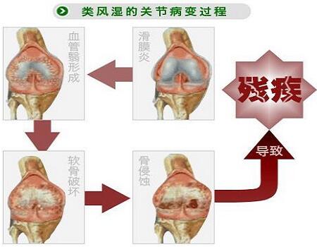 我们都知道类风湿是一种全身性慢性疾病,病程较长,尤其是发病时患者常独自承受着巨大的痛苦,因此患者很容易产生焦虑、烦躁、恐慌、悲观等不良情绪,甚至有些患者会出现自暴自弃的情况,而此时若能得到亲朋好友的支持和帮助,对于类风湿患者来说,无疑是吃了一颗定心丸,对他们的病情恢复也是大有益处。 病痛更见兄弟情!“没事,我给你养老” 本期节目患者可以说是不幸的,因为他患类风湿已经缠绵病榻多年,饱受折磨,但他也可以说是幸运的,因为病痛更见真感情,兄弟的一句“没事,我给你养老”让他内心升起阵阵暖意,他知道他并不是一个人在“战斗”,这也更坚定了他与类风湿抗争到底的决心。 蒙兴文主任表示,类风湿患者在确诊疾病之后及时接受治疗非常重要,但在接受治疗过程中,家属及亲友的精神支持和心理抚慰的重要性,绝对不亚于医生的专业治疗,那么作为患者的亲友,该如何做才能更好的帮助到他们? 给类风湿患者家属及亲友的几个建议 1、经常与患者沟通 病人亲友要表现出与患者共渡难关的意愿,必须学会聆听,耐心听病人的倾诉,与病人相互坦诚交谈。当病人发脾气时要耐心,表示出对他(她)的理解,并搞清发脾气的原因是身体不舒服,还是由于照顾不周。若病人表现出不需要别人帮助,也要弄明白他(她)是真的不需要别人帮助,还是内心存在其他消极想法。 2、了解疾病相关知识 类风湿患者的日常护理很重要,因此患者亲友应多了解一些与类风湿疾病相关的知识,了解疾病会给患者带来哪些不适、了解疾病的治疗、药物的副作用等,以便更好的照顾类风湿患者的饮食起居。 3、 关注他但不要过度保护他 虽然类风湿关节炎会造成患者的部分行动不便,但是他仍然可以做很多力所能及的事情, 如果给予他过度的保护,就像父母对孩子的溺爱一样,会让患者难以融入社会。 4、引导患者积极配合医生治疗 家属要帮助患者建立起良好的心态,鼓励他积极治疗,并且陪伴他一起去看医生,这样不仅可以让患者感受到被支持的温暖,家属还有机会和医生对话,把疑问告诉医生并直接从医生那里获得专业解答。 5、不停地做调整和适应 类风湿关节炎本身就是一个慢性反复疾病,如果用一张图表来描述这个疾病,这个图表一定不是直线,而是一个上下起伏的曲线。 随着疾病的变化,患者需要不停地调整自己的心理、状态和生活方式。而作为患者的亲友也必须根据这些变化作出相应的调整和适应。 类风湿并非不治之症,正规治疗有助康复 蒙兴文主任提醒广大类风湿患者及其亲友,类风湿性关节炎不是绝症,随着医学上对类风湿的深入研究,以及治疗理念的不断更新,类风湿性关节炎已经是一个可防、可治的疾病。之所以大家认为类风湿性关节炎是不治之症,主要是由于不正规治疗引起的,若能早期诊断、正规治疗,类风湿性关节炎是可以得到很好的控制,甚至完全康复。 节目预告 面对疾病侵袭,类风湿患者及其家属应如何正确处理?类风湿不及时治疗会出现哪些危害?类风湿如何治疗才能有效控制病情发展?2017年9月29日CDTV-3《热线188》栏目将邀请我院医生蒙兴文主任现场讲解,节目详情敬请期待! 我们都知道类风湿是一种全身性慢性疾病,病程较长,尤其是发病时患者常独自承受着巨大的痛苦,因此患者很容易产生焦虑、烦躁、恐慌、悲观等不良情绪,甚至有些患者会出现自暴自弃的情况,而此时若能得到亲朋好友的支持和帮助,对于类风湿患者来说,无疑是吃了一颗定心丸,对他们的病情恢复也是大有益处。 病痛更见兄弟情!“没事,我给你养老” 本期节目患者可以说是不幸的,因为他患类风湿已经缠绵病榻多年,饱受折磨,但他也可以说是幸运的,因为病痛更见真感情,兄弟的一句“没事,我给你养老”让他内心升起阵阵暖意,他知道他并不是一个人在“战斗”,这也更坚定了他与类风湿抗争到底的决心。 蒙兴文主任表示,类风湿患者在确诊疾病之后及时接受治疗非常重要,但在接受治疗过程中,家属及亲友的精神支持和心理抚慰的重要性,绝对不亚于医生的专业治疗,那么作为患者的亲友,该如何做才能更好的帮助到他们? 给类风湿患者家属及亲友的几个建议 1、经常与患者沟通 病人亲友要表现出与患者共渡难关的意愿,必须学会聆听,耐心听病人的倾诉,与病人相互坦诚交谈。当病人发脾气时要耐心,表示出对他(她)的理解,并搞清发脾气的原因是身体不舒服,还是由于照顾不周。若病人表现出不需要别人帮助,也要弄明白他(她)是真的不需要别人帮助,还是内心存在其他消极想法。 2、了解疾病相关知识 类风湿患者的日常护理很重要,因此患者亲友应多了解一些与类风湿疾病相关的知识,了解疾病会给患者带来哪些不适、了解疾病的治疗、药物的副作用等,以便更好的照顾类风湿患者的饮食起居。 3、 关注他但不要过度保护他 虽然类风湿关节炎会造成患者的部分行动不便,但是他仍然可以做很多力所能及的事情, 如果给予他过度的保护,就像父母对孩子的溺爱一样,会让患者难以融入社会。 4、引导患者积极配合医生治疗 家属要帮助患者建立起良好的心态,鼓励他积极治疗,并且陪伴他一起去看医生,这样不仅可以让患者感受到被支持的温暖,家属还有机会和医生对话,把疑问告诉医生并直接从医生那里获得专业解答。 5、不停地做调整和适应 类风湿关节炎本身就是一个慢性反复疾病,如果用一张图表来描述这个疾病,这个图表一定不是直线,而是一个上下起伏的曲线。 随着疾病的变化,患者需要不停地调整自己的心理、状态和生活方式。而作为患者的亲友也必须根据这些变化作出相应的调整和适应。 类风湿并非不治之症,正规治疗有助康复 蒙兴文主任提醒广大类风湿患者及其亲友,类风湿性关节炎不是绝症,随着医学上对类风湿的深入研究,以及治疗理念的不断更新,类风湿性关节炎已经是一个可防、可治的疾病。之所以大家认为类风湿性关节炎是不治之症,主要是由于不正规治疗引起的,若能早期诊断、正规治疗,类风湿性关节炎是可以得到很好的控制,甚至完全康复。 节目预告 面对疾病侵袭,类风湿患者及其家属应如何正确处理?类风湿不及时治疗会出现哪些危害?类风湿如何治疗才能有效控制病情发展?2017年9月29日CDTV-3《热线188》栏目将邀请我院医生蒙兴文主任现场讲解,节目详情敬请期待!