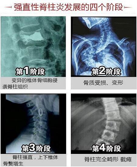 患者心声:患上强直病25年,他只愿不瘫痪! 患者心声:患上强直病25年,他只愿不瘫痪!