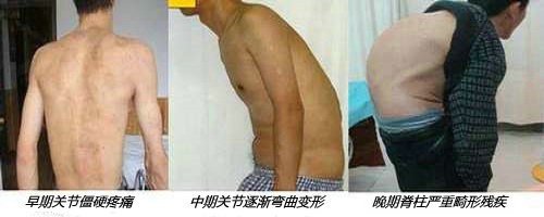 患者心声:患上强直病25年,他只愿不瘫痪! 患者心声:患上强直病25年,他只愿不瘫痪!