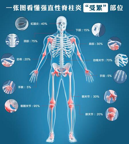 患者心声:患上强直病25年,他只愿不瘫痪! 患者心声:患上强直病25年,他只愿不瘫痪!