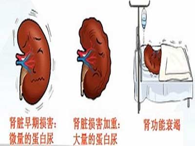 痛风严重之后出现肾衰竭该怎么办呢？