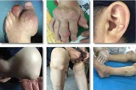 双脚长痛风石,他截掉脚趾保命!痛风石的危害有哪些? 双脚长痛风石,他截掉脚趾保命!痛风石的危害有哪些?
