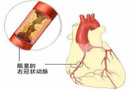 双脚长痛风石,他截掉脚趾保命!痛风石的危害有哪些? 双脚长痛风石,他截掉脚趾保命!痛风石的危害有哪些?