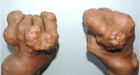 手脚发麻是风湿骨病的现象吗？要重视起来了
