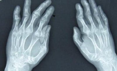成都风湿病专科医院：为什么手掌疼痛会患上类风湿？你了解类风湿的病因