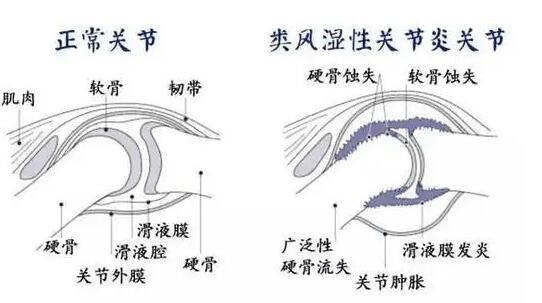  中老年人要如何预防类风湿关节炎 有哪些措施？