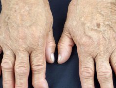 成都风湿医院:类风湿变形的手指怎么才可以恢复?